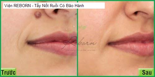 Ngoại thât Viện REBORN - Tẩy Nốt Ruồi Có Bảo Hành