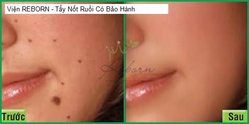 Chất lượng Viện REBORN - Tẩy Nốt Ruồi Có Bảo Hành