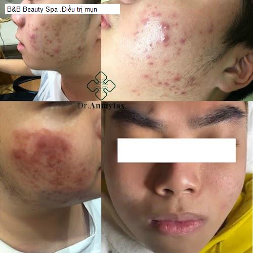 Bảng giá B&B Beauty Spa .Điều trị mụn