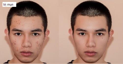 Cảnh quan trị mụn